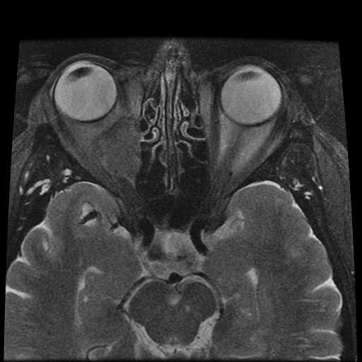 File:Carcinoid tumor of the ileum with metastasis to orbit (Radiopaedia 28165-28424 Axial T2 9).jpg