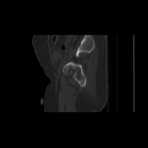 File:Carcinoma cervix- brachytherapy applicator (Radiopaedia 33135-34173 Sagittal bone window 25).jpg