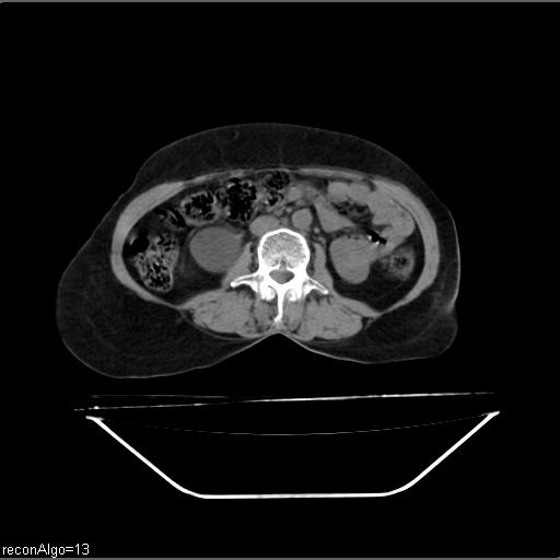 File:Carcinoma cervix- recurrence (Radiopaedia 34702-36137 Axial non-contrast 27).jpg