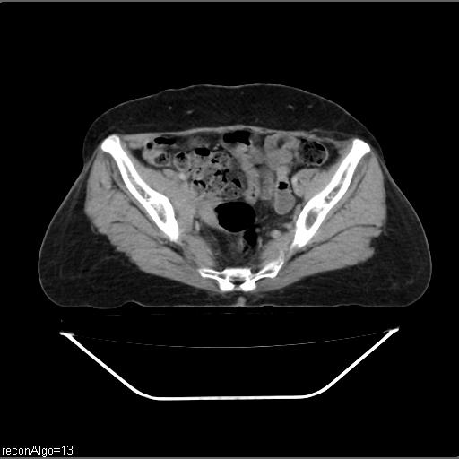 File:Carcinoma cervix- recurrence (Radiopaedia 34702-36137 B 43).jpg
