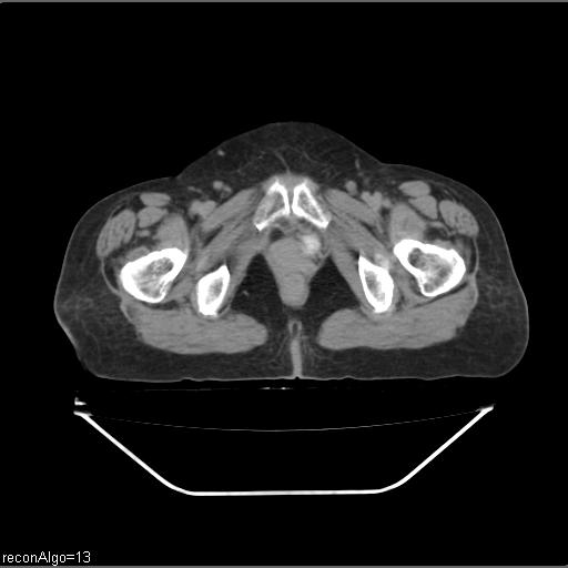 Carcinoma cervix- recurrence (Radiopaedia 34702-36137 B 91).jpg