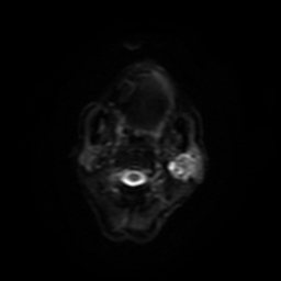 Carcinoma ex-pleomorphic adenoma of parotid (Radiopaedia 28383-28627 Ax DWI B-500 GE 15).jpg