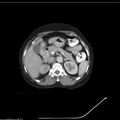 File:Carcinoma of the cervix (Radiopaedia 23536).jpg