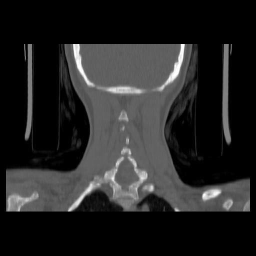 Carcinoma of the maxillary antrum (Radiopaedia 53805-59888 Coronal bone window 127).jpg