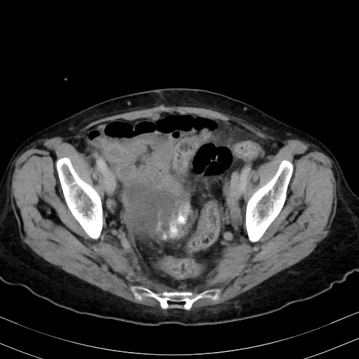 Carcinosarcoma (Radiopaedia 70401-80503 A 56).jpg