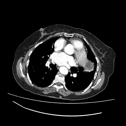 File:Cardiac hydatid disease (Radiopaedia 64684-73611 Axial with contrast 25).jpg