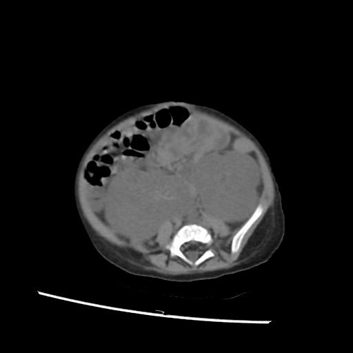 File:Caroli disease with autosomal recessive polycystic kidney disease (ARPKD) (Radiopaedia 89651-106703 Axial non-contrast 41).jpg