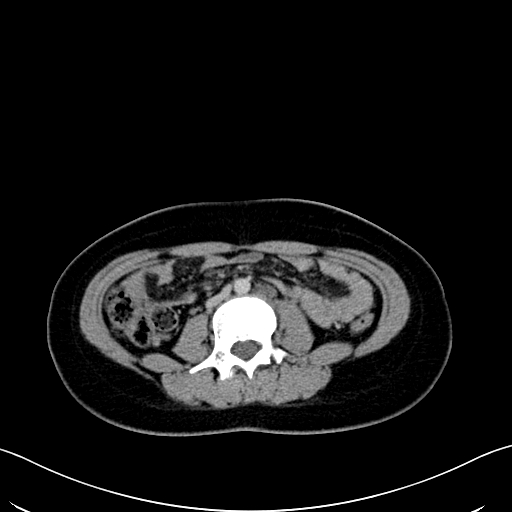 Caroli disease with medullary sponge kidney (Radiopaedia 82622-96804 C 40).jpg