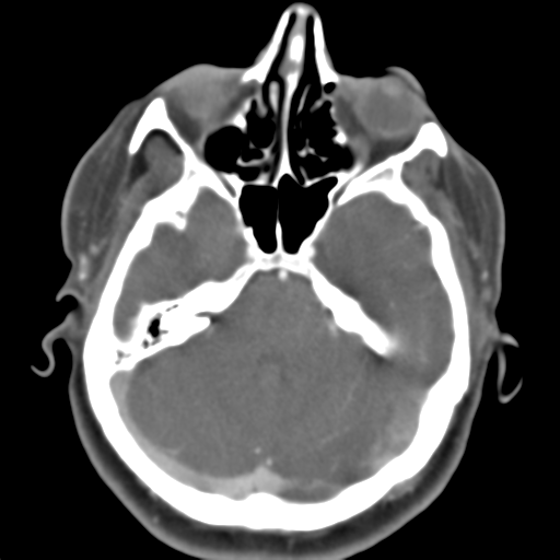 Carotico ophthalmic aneurysm (Radiopaedia 42916-46148 A 39).png
