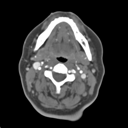 Carotico ophthalmic aneurysm (Radiopaedia 42916-46148 A 63).png