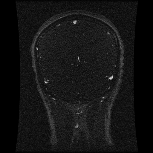 Carotid arterial dissection with acute cerebral infarction (Radiopaedia 26636-26784 MRV 63).jpg