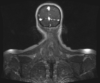 Carotid body tumor (Radiopaedia 12777-12912 MRA 74).jpg