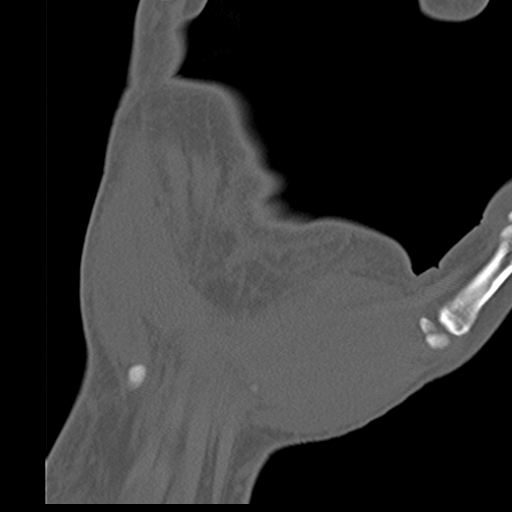 File:Carpo-metacarpal fracture-dislocations with hamatum split fracture (Radiopaedia 18482-18343 Coronal bone window 19).jpg