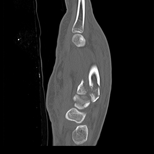 File:Carpo-metacarpal fracture-dislocations with hamatum split fracture (Radiopaedia 18482-18343 Sagittal bone window 18).jpg