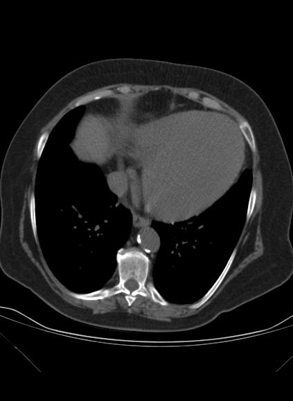 File:Caseous mitral annular calcification (Radiopaedia 61219-69122 Axial non-contrast 16).jpg