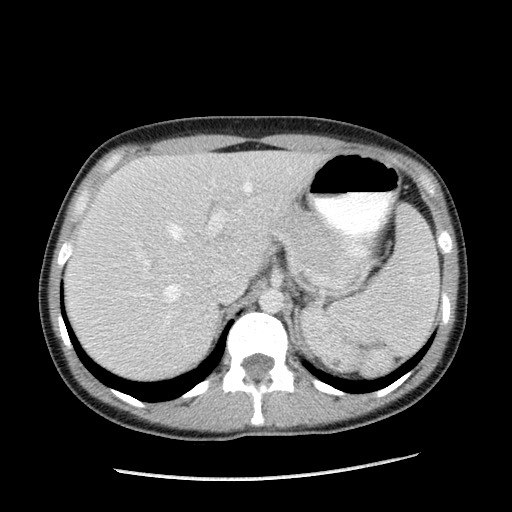 Castleman disease with fibrous pseudotumor in the abdomen (Radiopaedia 77296-89373 A 28).jpg