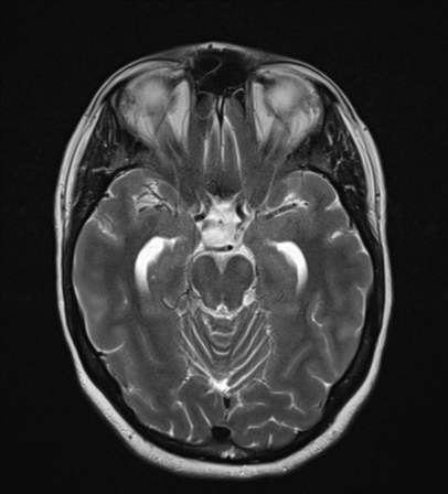 File:Cavernoma with bleed - midbrain (Radiopaedia 54546-60774 Axial T2 10).png