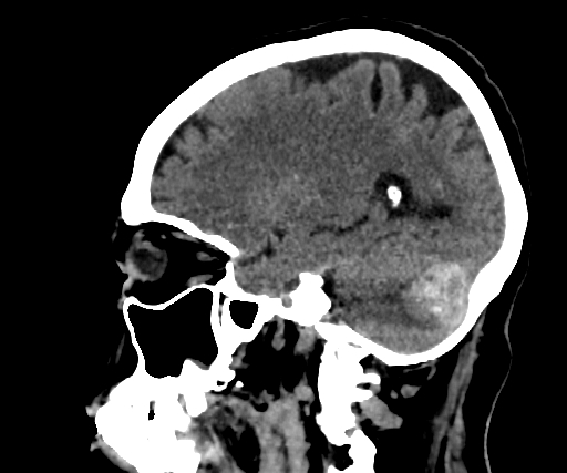 Cavernous hemangioma of the cerebellar falx (Radiopaedia 73025-83723 B 114).jpg