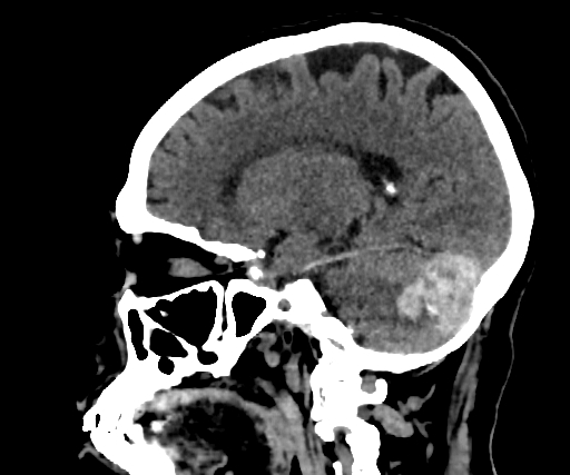 Cavernous hemangioma of the cerebellar falx (Radiopaedia 73025-83723 B 126).jpg