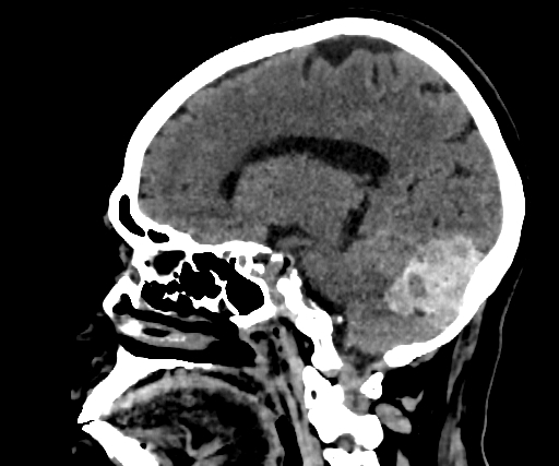 Cavernous hemangioma of the cerebellar falx (Radiopaedia 73025-83723 B 136).jpg