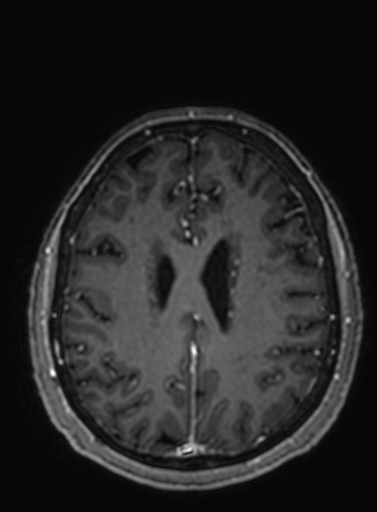 Cavernous hemangioma of the cerebellar falx (Radiopaedia 73025-83724 Axial T1 C+ 111).jpg