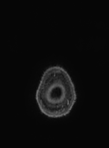 File:Cavernous hemangioma of the cerebellar falx (Radiopaedia 73025-83724 Axial T1 C+ 2).jpg