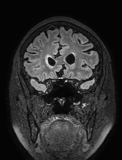 Cavernous hemangioma of the cerebellar falx (Radiopaedia 73025-83724 Coronal FLAIR 101).jpg
