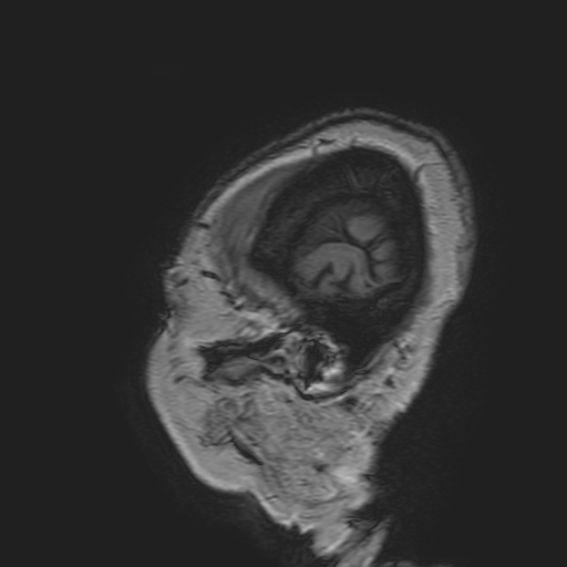 File:Cavernous hemangioma of the cerebellar falx (Radiopaedia 73025-83724 Sagittal T1 15).jpg