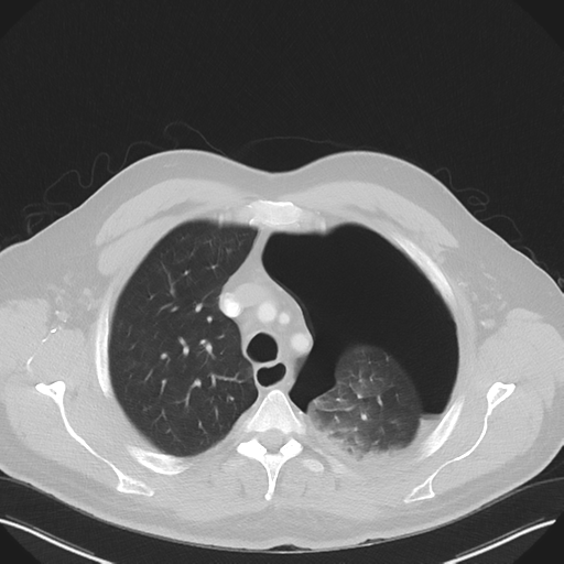 File:Cavitating pneumonia complicated by pneumothorax (Radiopaedia 48149-52994 Axial lung window 17).png