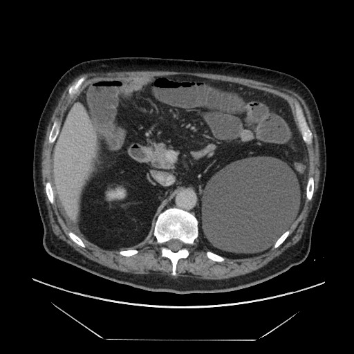 Cecal adenocarcinoma (Radiopaedia 64871-73817 A 28).jpg