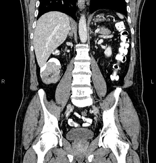 Cecal adenocarcinoma (Radiopaedia 85324-100916 D 39).jpg