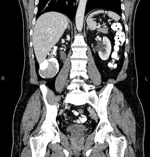 Cecal adenocarcinoma (Radiopaedia 85324-100916 D 42).jpg