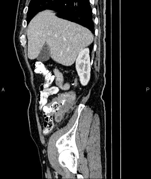 File:Cecal cancer with appendiceal mucocele (Radiopaedia 91080-108651 E 21).jpg