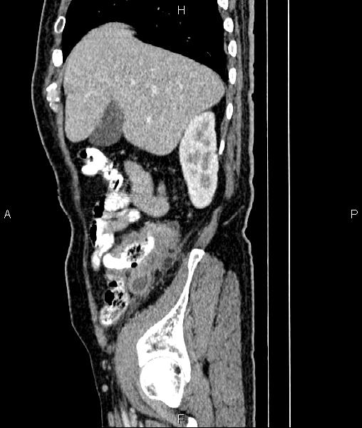 Cecal cancer with appendiceal mucocele (Radiopaedia 91080-108651 E 22).jpg