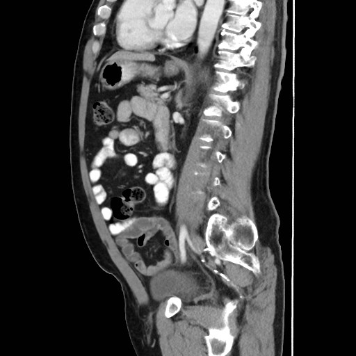 Cecal mass causing appendicitis (Radiopaedia 59207-66531 C 39).jpg