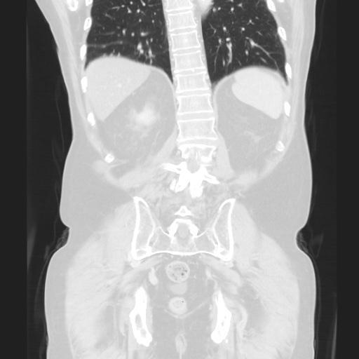 Cecal volvulus (Radiopaedia 75378-86620 Coronal lung window 104).jpg