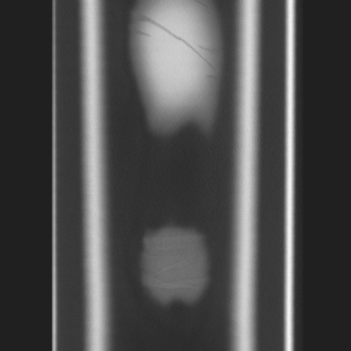 Cecal volvulus (Radiopaedia 75378-86620 Coronal lung window 133).jpg