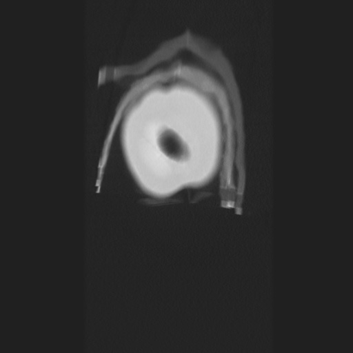 Cecal volvulus (Radiopaedia 75378-86620 Coronal lung window 8).jpg