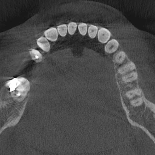 Cemento-osseous dysplasia (Radiopaedia 48251-53126 Axial non-contrast 52).jpg