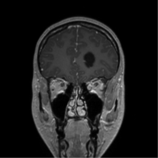 Central neurocytoma (Radiopaedia 37664-39557 Coronal T1 C+ 68).png