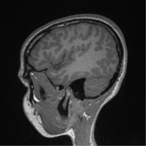 Central neurocytoma (Radiopaedia 37664-39557 Sagittal T1 22).png
