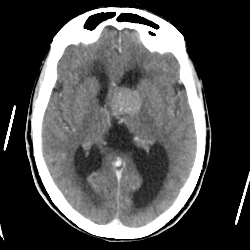 Central neurocytoma (Radiopaedia 65317-74346 Axial C+ delayed 25).png