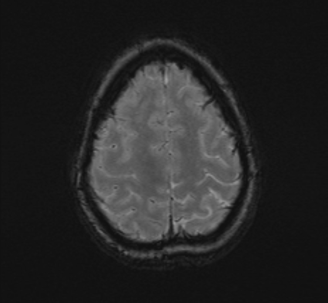 Central neurocytoma (Radiopaedia 70263-80336 Axial SWI 51).jpg
