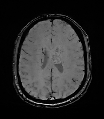 File:Central neurocytoma (Radiopaedia 71068-81303 Axial SWI 42).jpg