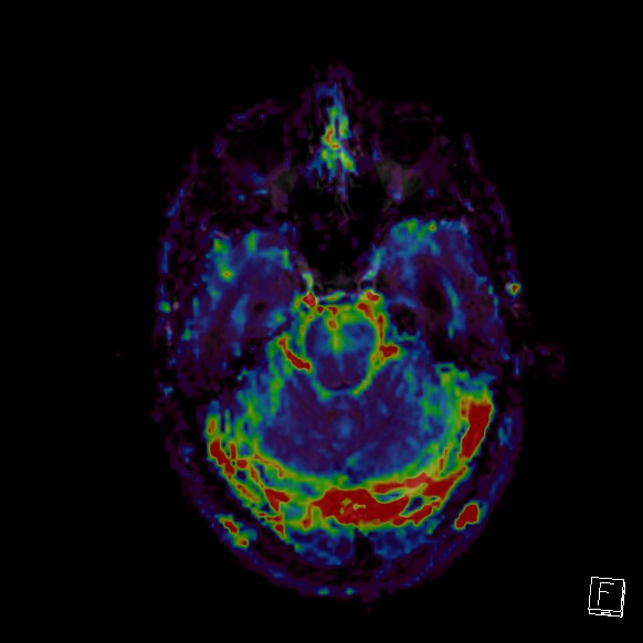 Central neurocytoma (Radiopaedia 84497-99872 Axial Perfusion 233).jpg