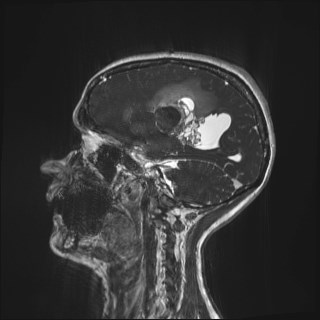 Central neurocytoma (Radiopaedia 84497-99872 Sagittal CISS 63).jpg