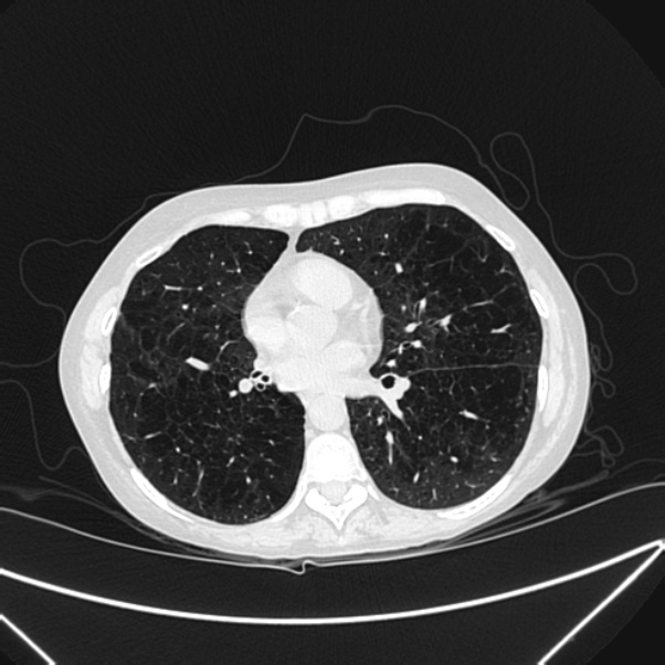 Centrilobular pulmonary emphysema (Radiopaedia 24495-24789 Axial lung window 55).jpg