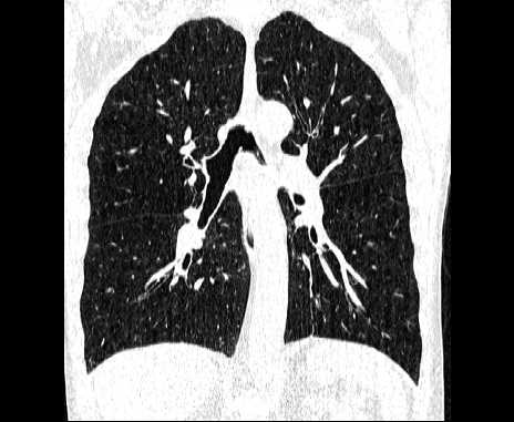 Centrilobular pulmonary emphysema (Radiopaedia 62468-70718 Coronal lung window 43).jpg