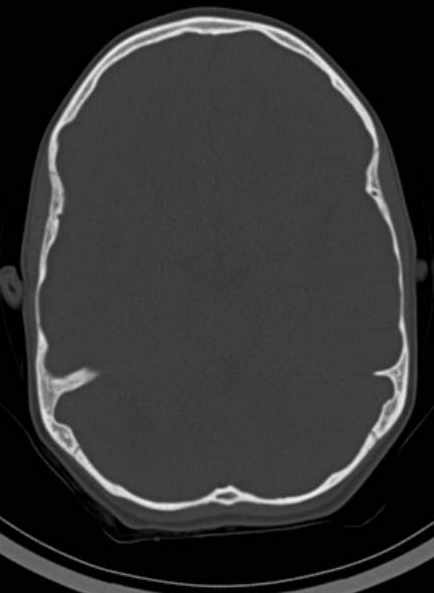 Cerebellar abscess (Radiopaedia 73727-84527 Axial bone window 31).jpg