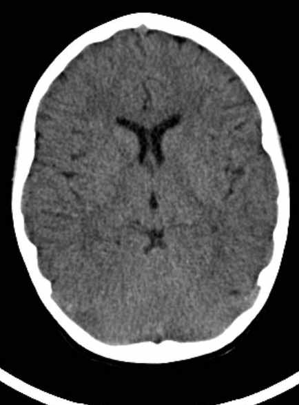 Cerebellar abscess (Radiopaedia 73727-84527 Axial non-contrast 38).jpg